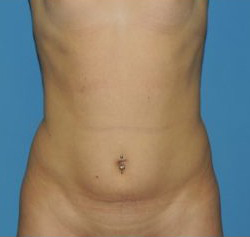 Vaser Liposuction Before & After Patient #264