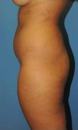Vaser Liposuction Before & After Patient #259