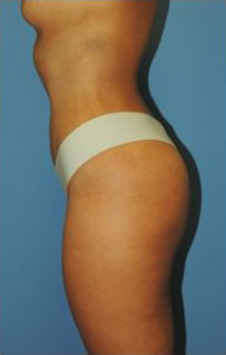 Vaser Liposuction Before & After Patient #259