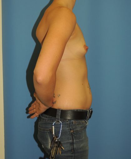 Breast Augmentation Before & After Patient #4695