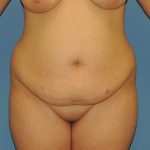 Tummy Tuck Before & After Patient #4908