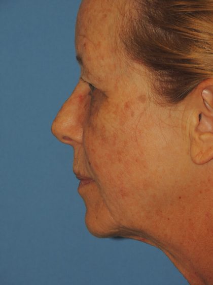 Enzo Skin Resurfacing Before & After Patient #4915