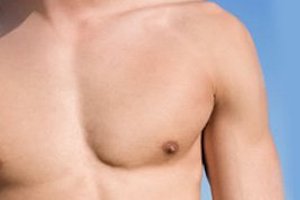 Does Gynecomastia Go Away on Its Own?